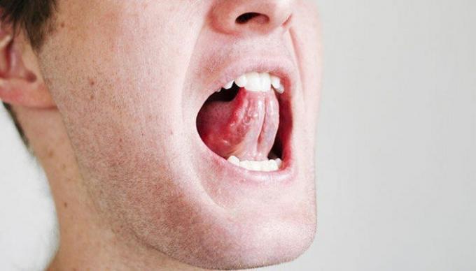 Een paar eenvoudige oefeningen voor de keel en tong kan de situatie te verlichten met snurken. / Foto: i2.wp.com. 